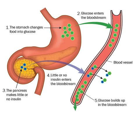 Insulin Pancreas Diagram