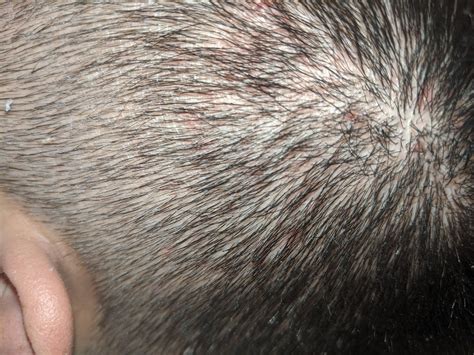 Itchy and scabby scalp. Need advice. : HaircareScience