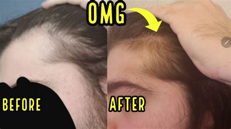 News – Tagged "oral minoxidil"– HAIRLICIOUSLY