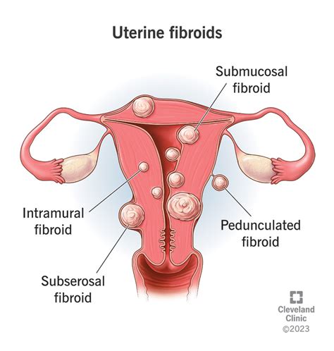 Understanding Fibroids: Causes, Symptoms, And Treatments - Ask The ...