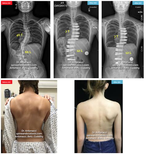 Scoliosis Surgery Gone Wrong