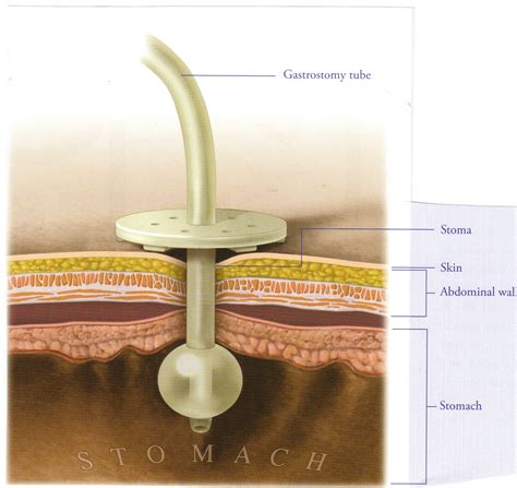 Our Life And Such: The Gastrostomy Tube