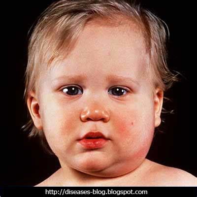 Health And Diseases Blog: Mumps