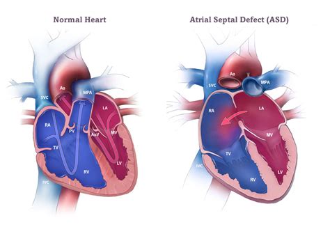 Atrial Septal Defect - ACHA