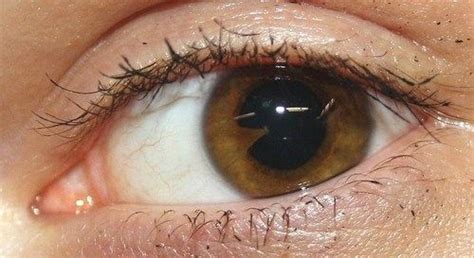 Synechiae is an eye problem in which adhesions form between the iris ...