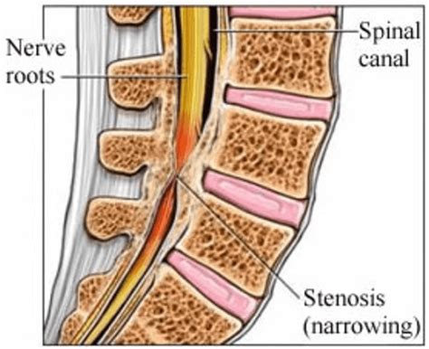 Pictures Of Stenosis Of The Spine - Janio-Cesar