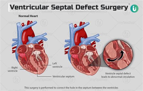 Ventricular septal defect surgery: Procedure, Purpose, Results, Cost, Price