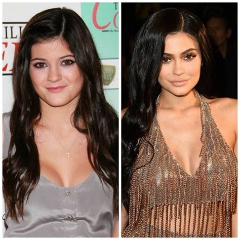 Kylie Jenner Before and After Plastic Surgery Photos Reveal Drastic ...