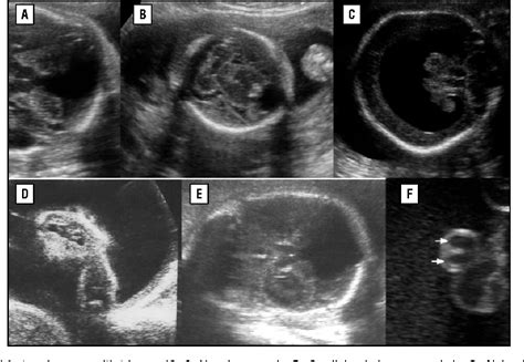 Trisomy 18 Ultrasound 13 Weeks