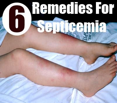 6 Amazing Home Remedies For Septicemia - Natural Treatments & Cures ...