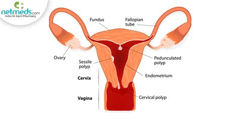 Cervical Polyps