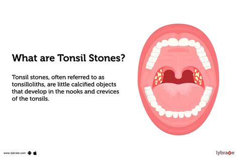 Tonsil stones: Symptoms, Causes Treatments And Cost