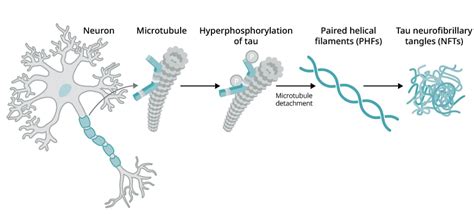 Tau Propagation Influences Alzheimer's Disease Progression, 52% OFF