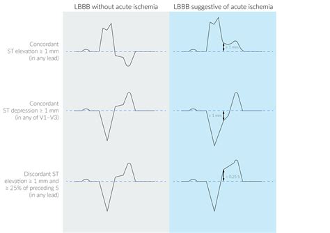 Unstable Angina Ecg