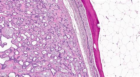 Pleomorphic Adenoma Pathology