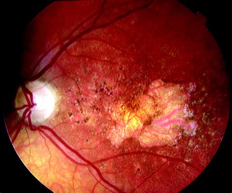 Age related macular degeneration | The BMJ