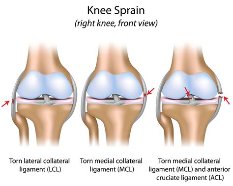 Two Boneheads Video Series: The MCL Sprain - Town Center Orthopaedics