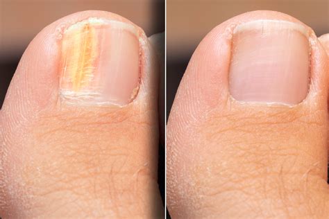 Erwiesen: So kannst du Nagelpilz wirklich loswerdenWelt der Kinderknete