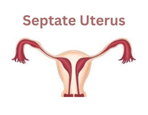 Septate Uterus (Uterine Septum): Causes, Symptoms, and Treatment ...