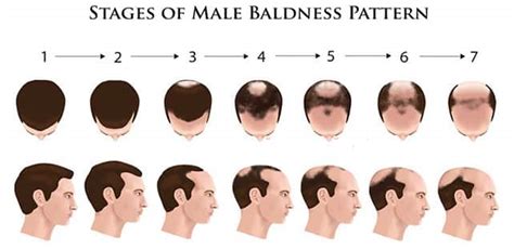 Causes of Male Pattern Baldness and Prevention | Hair sure