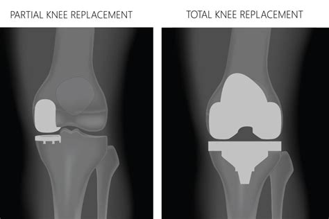 Partial knee replacement vs. total knee replacement