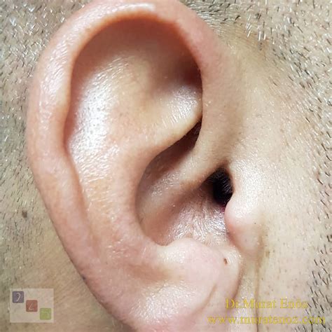 Two Months After Endoscopic Eardrum Repair