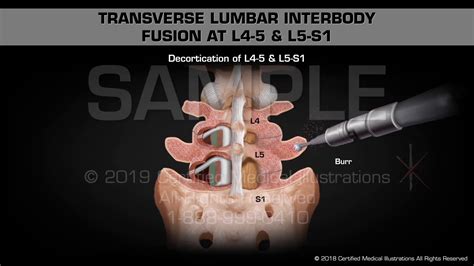 Transverse Lumbar Interbody Fusion at L4-5 & L5-S1 - Medical Animation ...