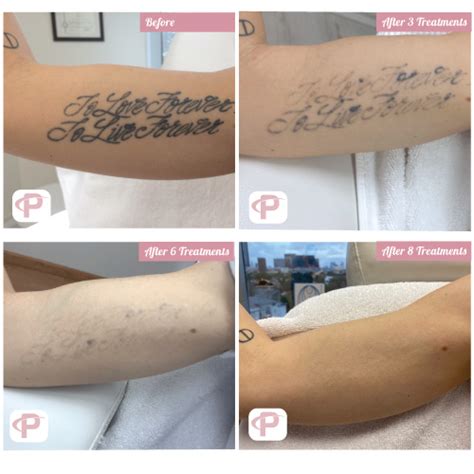 laser tattoo removal progress pictures - fashionphotographyclipart