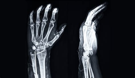 Wrist X-Ray: Anatomy, Procedure & What to Expect