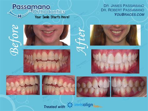 Large Open Bite Closed with Invisalign Teen - Passamano Orthodontics