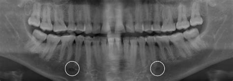 Mandibular Foramen Radiograph