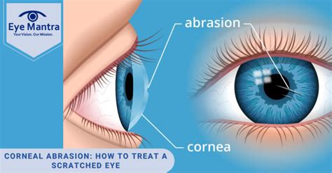 Corneal Abrasion: How to Treat a Scratched Eye | Eyemantra Hospital