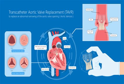 Effective Treatment options for Aortic Stenosis in India! | Add More to ...