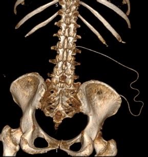 Lumboperitoneal shunt | Image | Radiopaedia.org