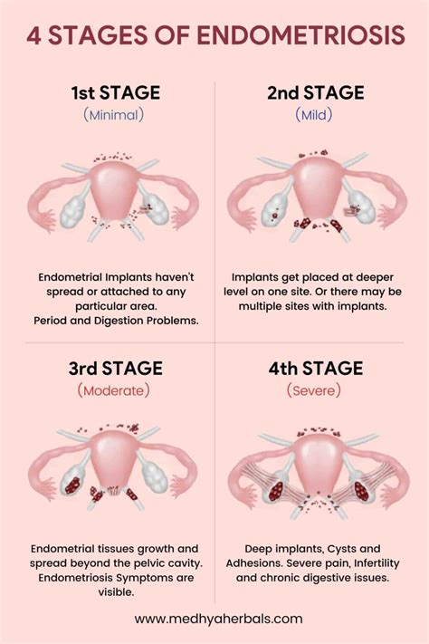 Endometriosis Symptoms: 5 Early Signs You Shouldn't Ignore