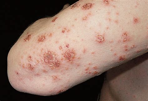 Severe, Generalized Nummular Eczema Secondary to Interferon Alfa-2b ...