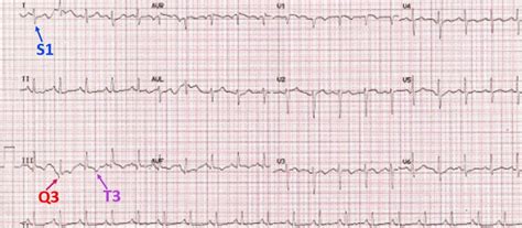 pulmonary disease pattern ecg Hình ảnh có liên quan - Diseases Club ...