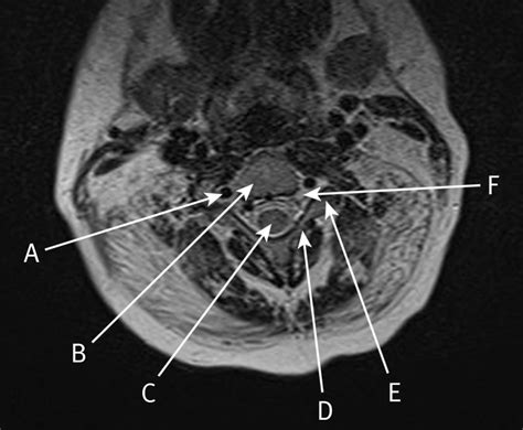 Mri Spine Anatomy Free Mri Axial Cervical Spine Anatomy Anatomy ...