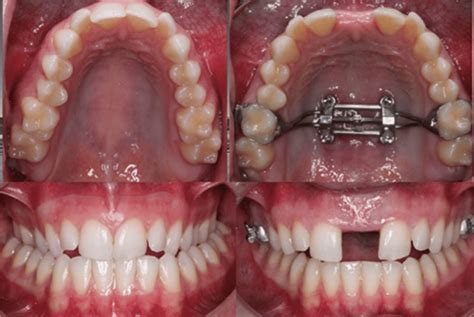 Bottom Palate Expander