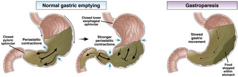 Gastroparesis - AGA GI Patient Center