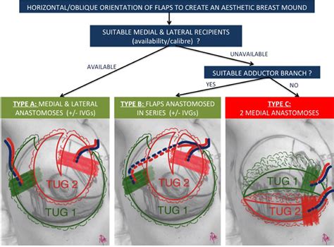 Unilateral breast reconstruction using double transverse upper gracilis ...