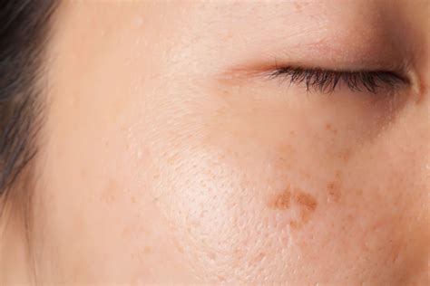 What Causes Brown Spots on the Skin? - Beverly Hills MD