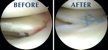 Effective treatment for a medial meniscus tear - Environmental ...