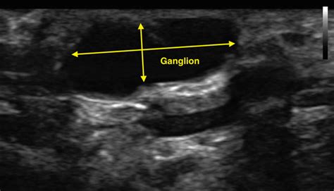 Ganglion Cyst Ultrasound