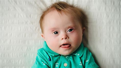 Four in five children with Down syndrome are born to mothers under the ...