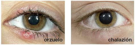 CHALAZION Y ORZUELO PDF