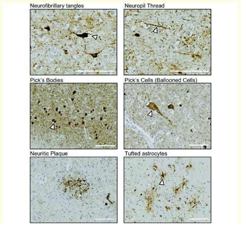 Features of tau pathology in human FTLD-tau. Immunohistochemical ...