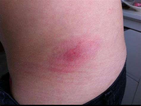 Bullseye rash? I woke up with this, so I'm not sure if I was bitten or ...