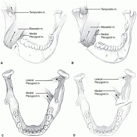 Mandibular Fracture Classification