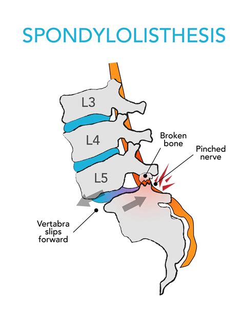 Complete Car Physio - Spondylolisthesis Exercises